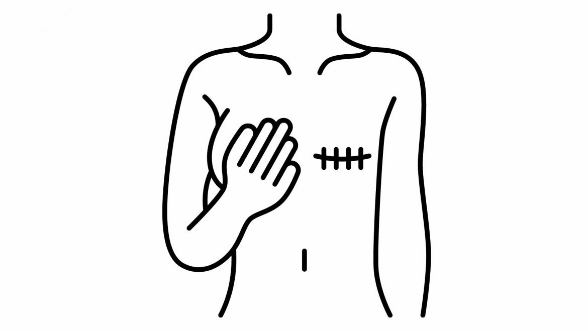 Mastectomia simple